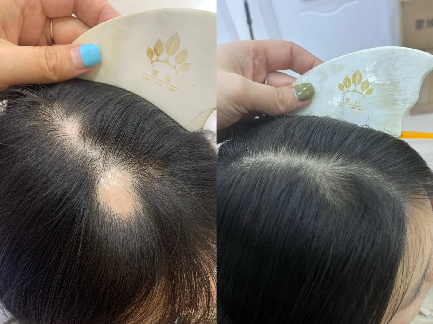 斑秃中医怎么治疗？新加坡贡方堂TCM陈慧芳内调外养效果翻倍